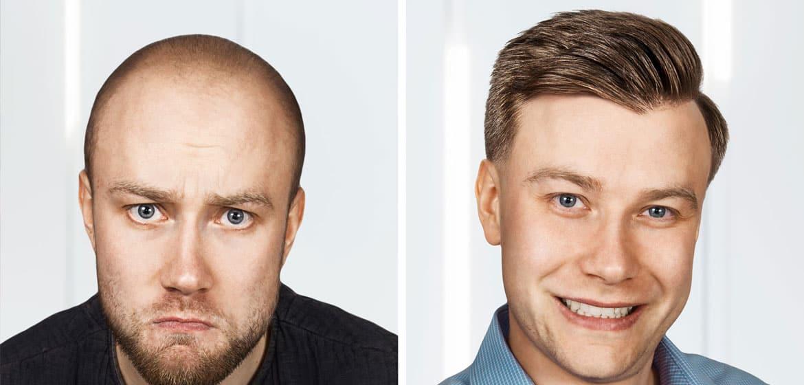 public/uploads/2022/01/Hair-Transplant-success-rate-1.jpg