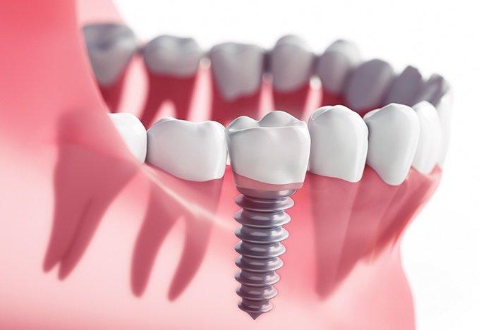 public/uploads/2022/03/How-many-years-do-dental-implants-last.jpg