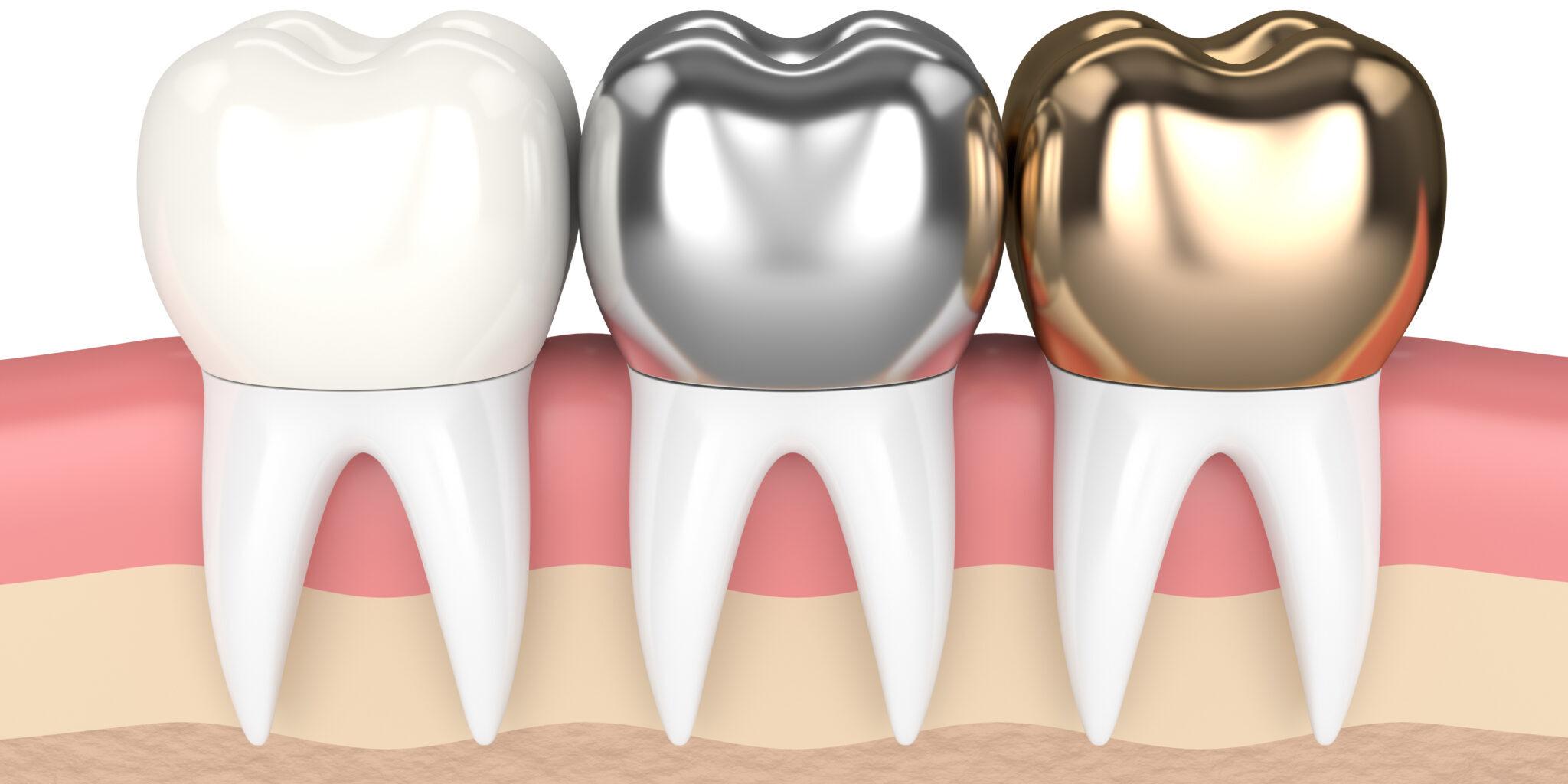 public/uploads/2023/03/dental-crown.jpg